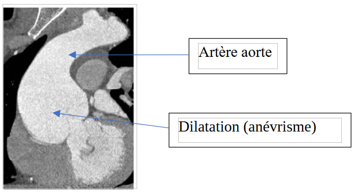 Anévrisme de l’artère aorte